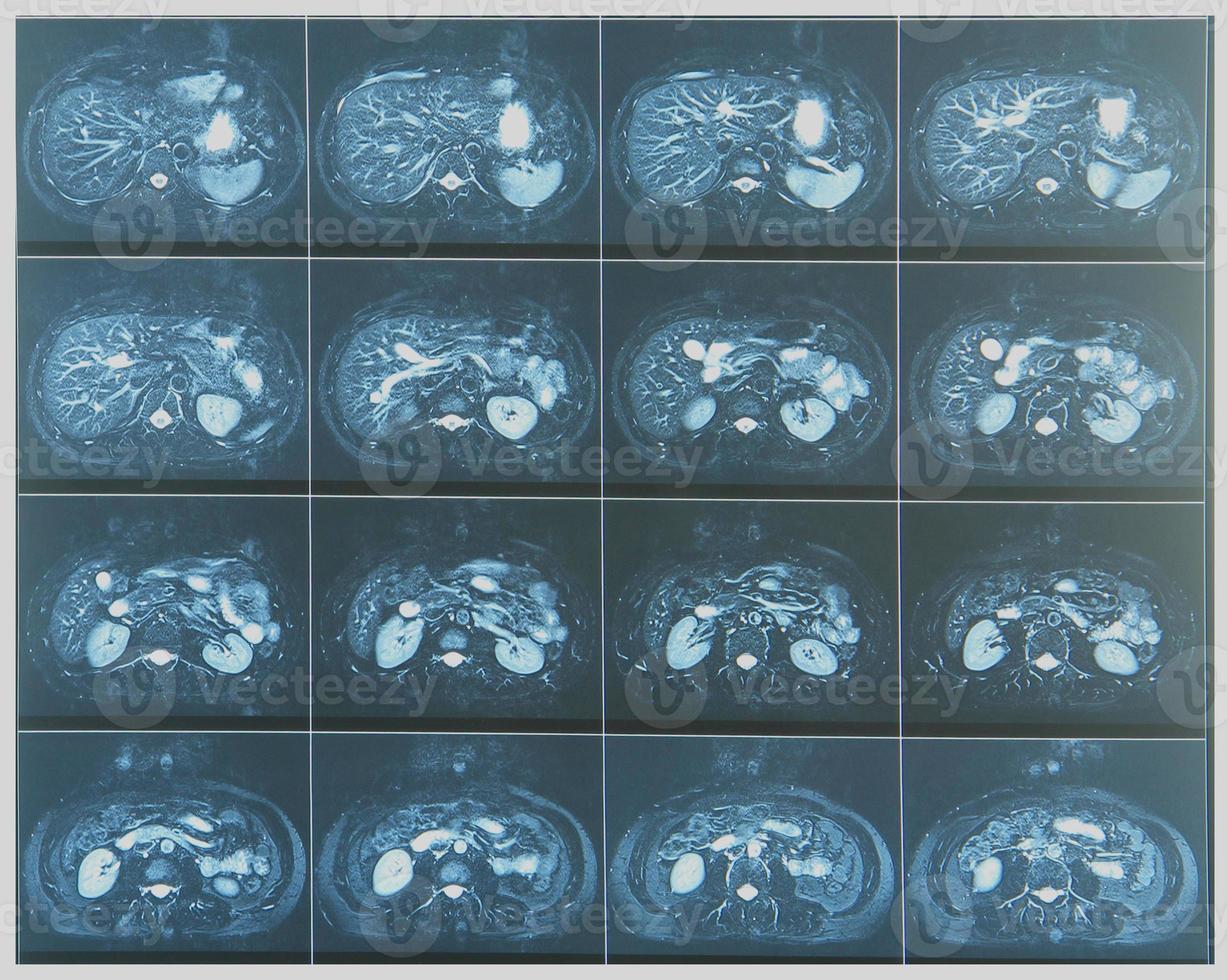 Abdomen MRI scan photo