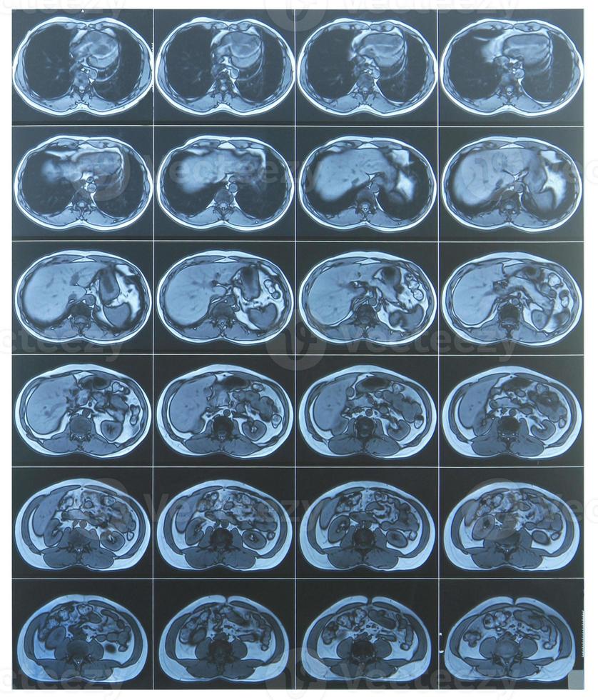 Abdomen MRI scan photo