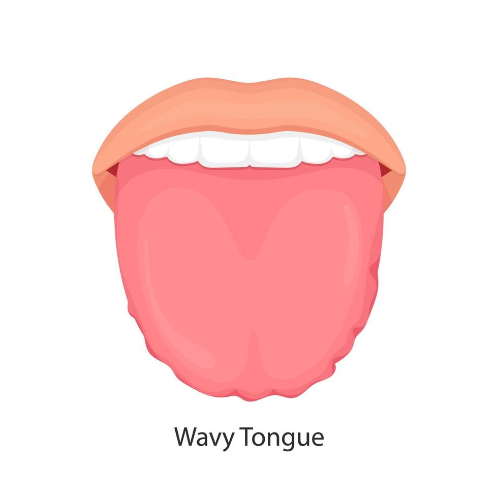 lengua blanca agrandada hinchada con bordes festoneados ondulados vector