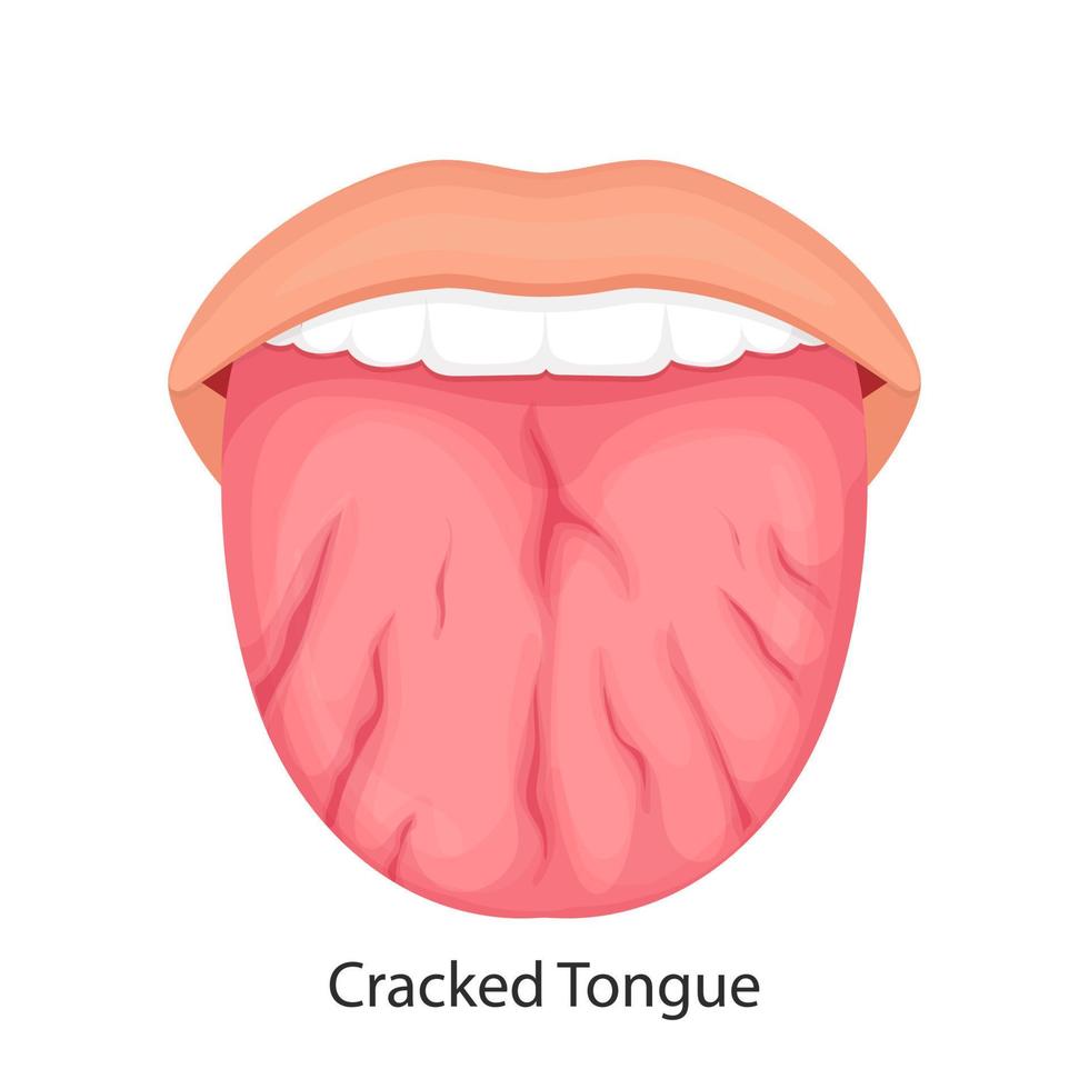 Disease of the tongue, cracks. medical illustration. vector