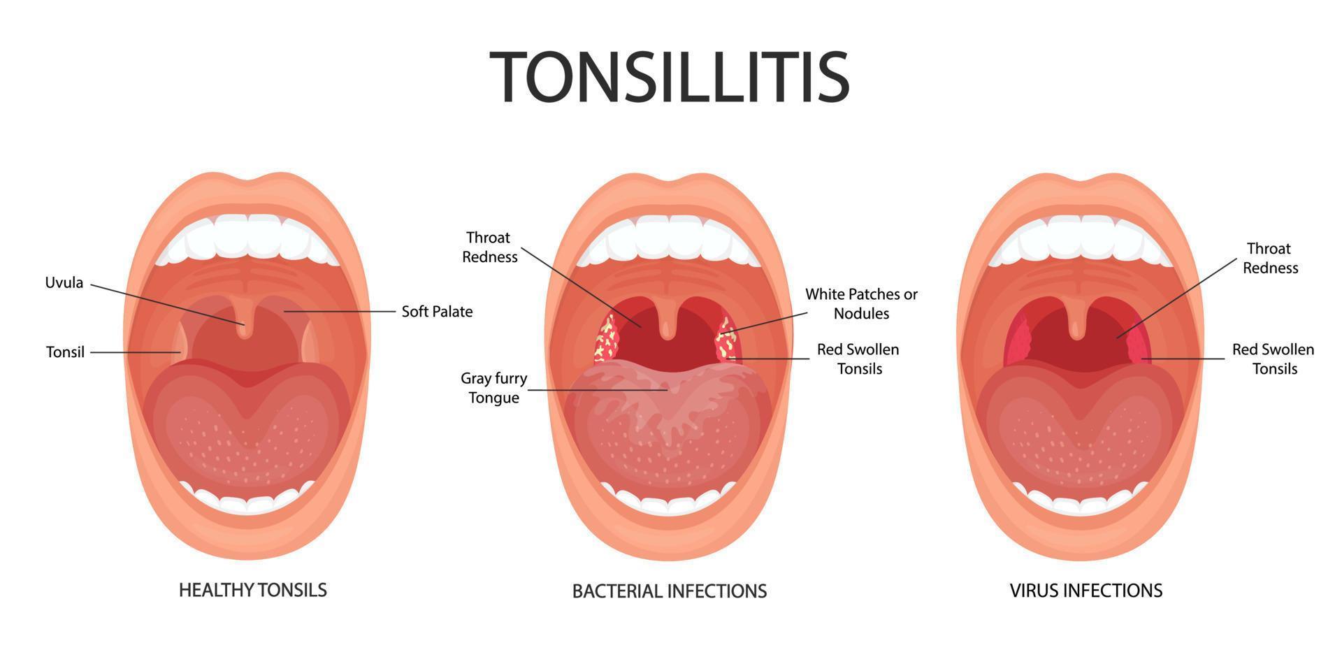 angina, faringitis y amigdalitis. amigdalitis bacteriana y viral. infección de amígdalas boca abierta, anatomía. vector