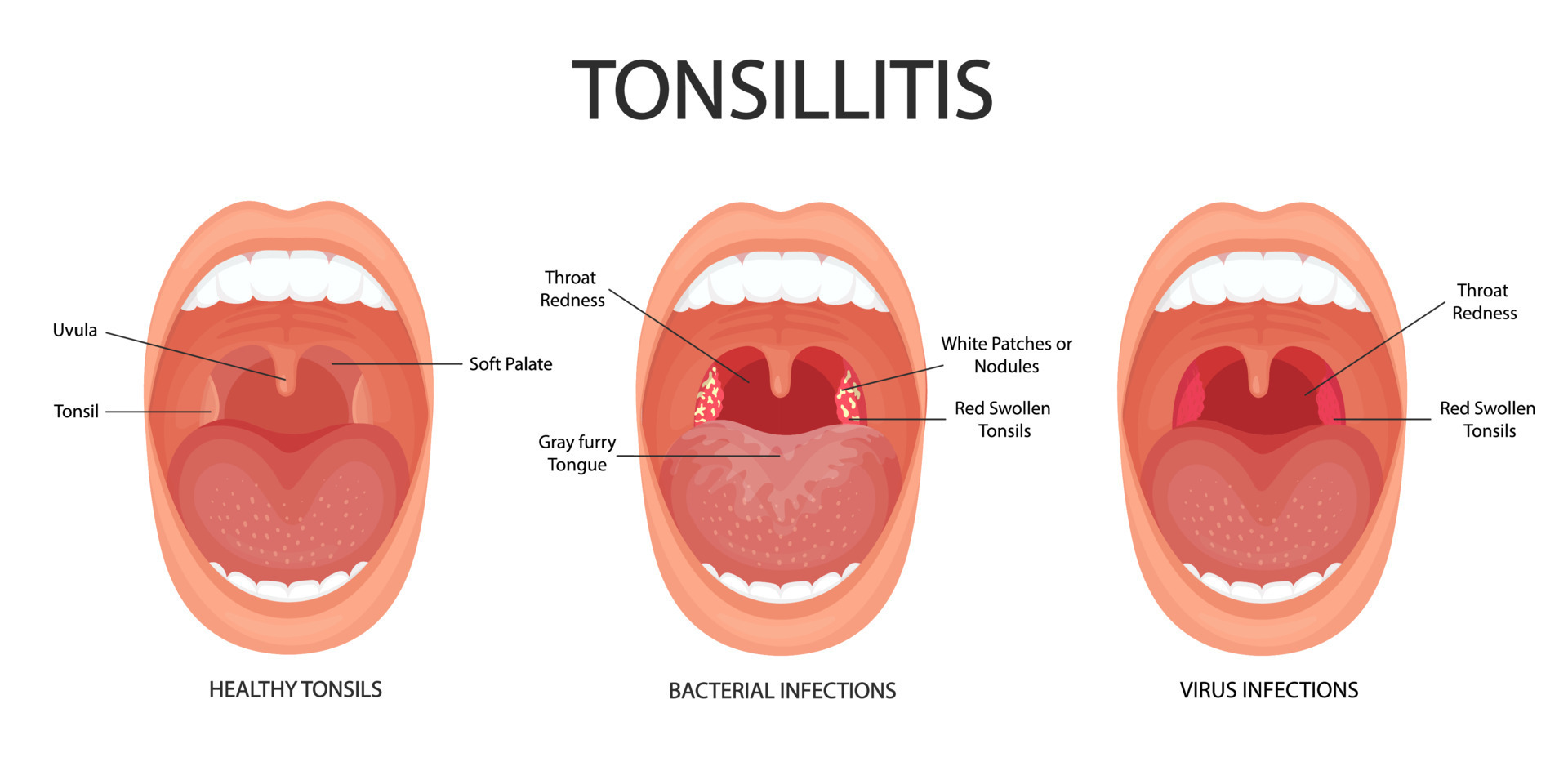 Angina Pharyngitis And Tonsillitis Tonsillitis Bacterial And Viral Tonsil Infection Open