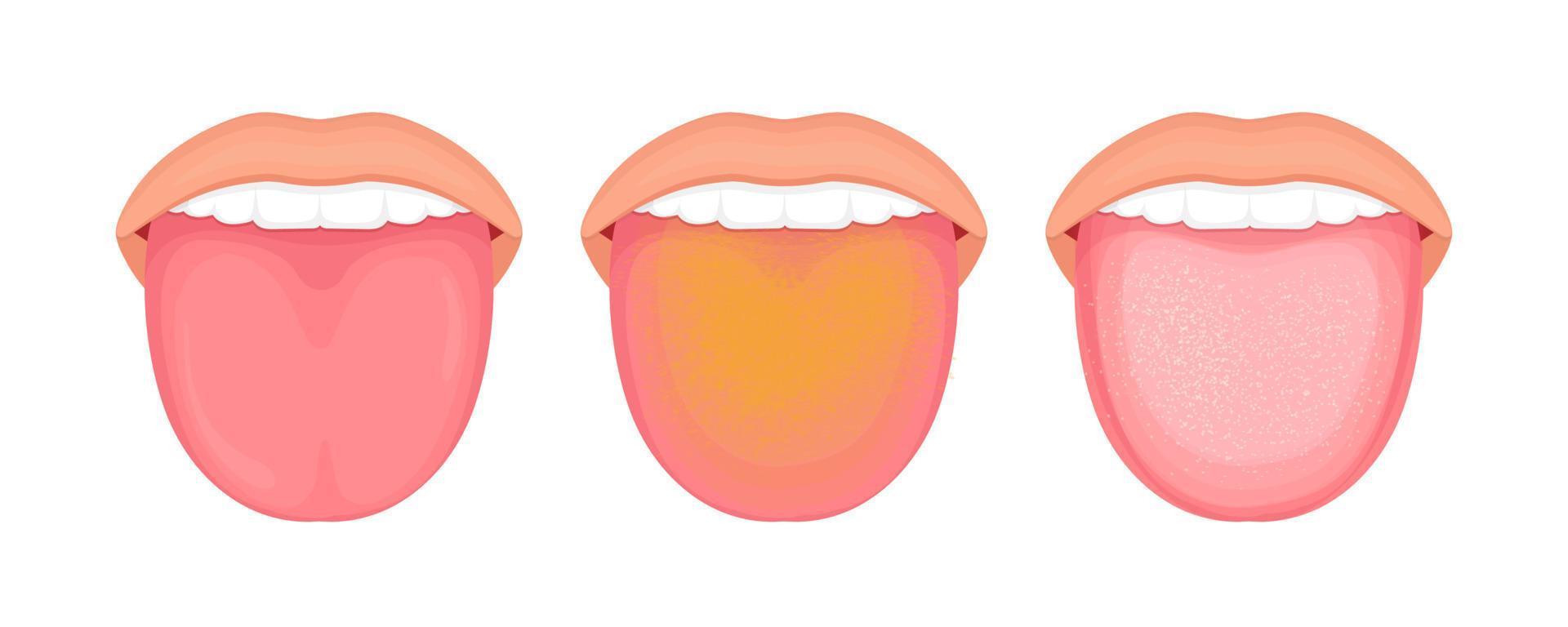 Illustration of tongue symptoms and health. medical illustration. vector