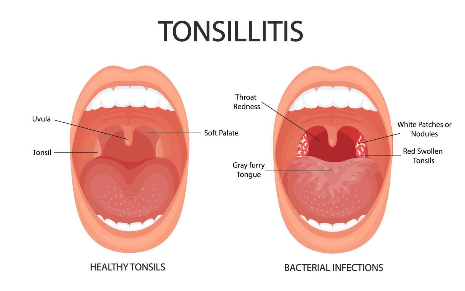 angina, faringitis y amigdalitis. la amigdalitis es bacteriana. infección de amígdalas boca abierta, anatomía. vector