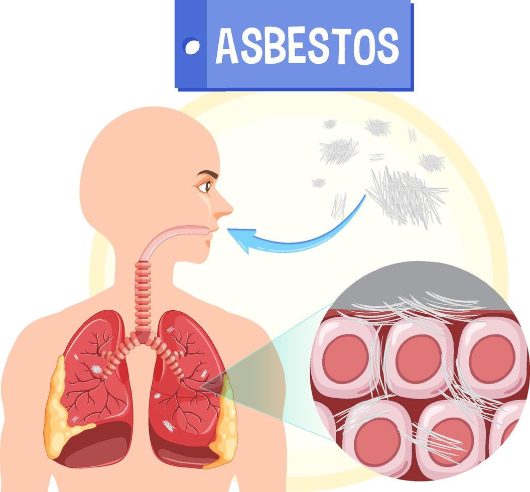 Diagram showing asbestosis in lungs vector