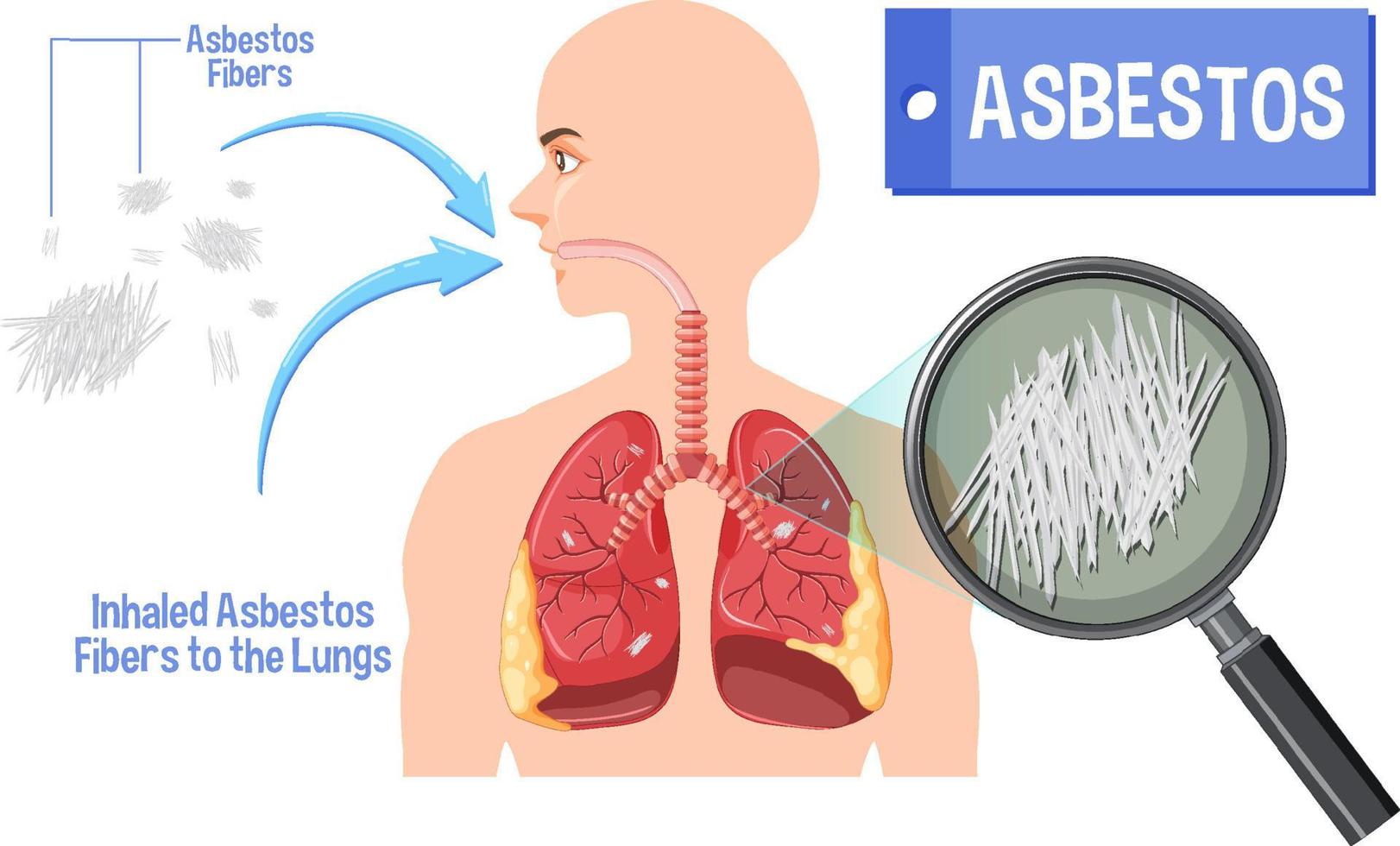 Diagram showing asbestosis in lungs vector