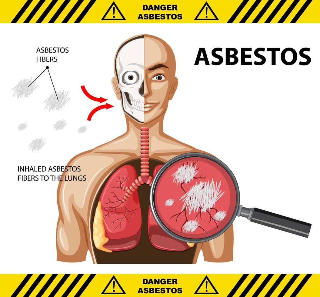 Diagram showing asbestosis in lungs vector