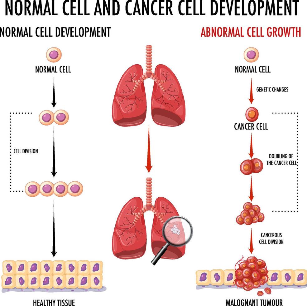 diagrama que muestra el proceso de desarrollo del cáncer vector