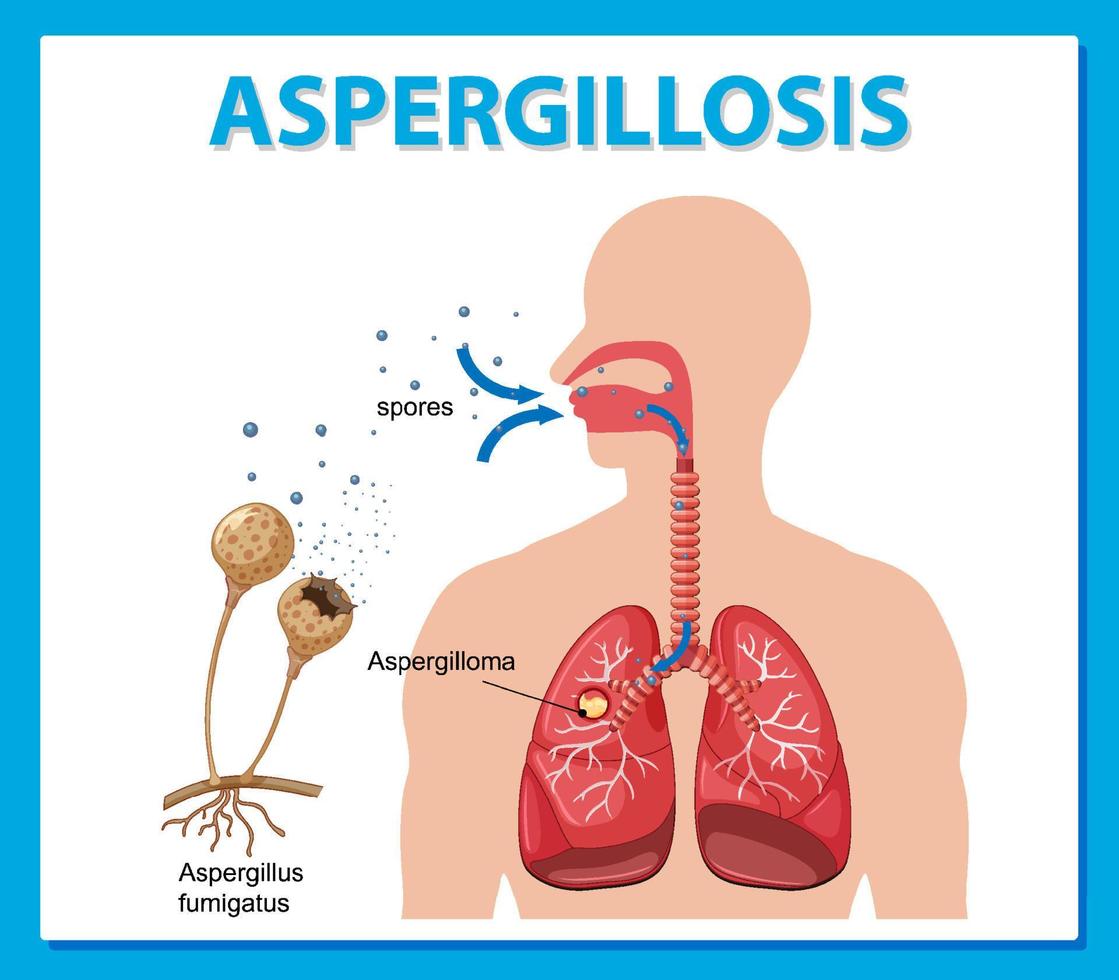 Diagram showing aspergillus infection vector