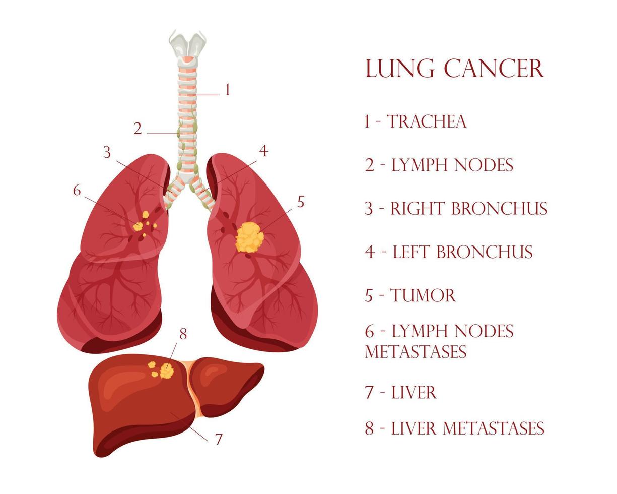 Diagram lung cancer disease. Concept disease human internal organs. Vector illustration, cartoon style.