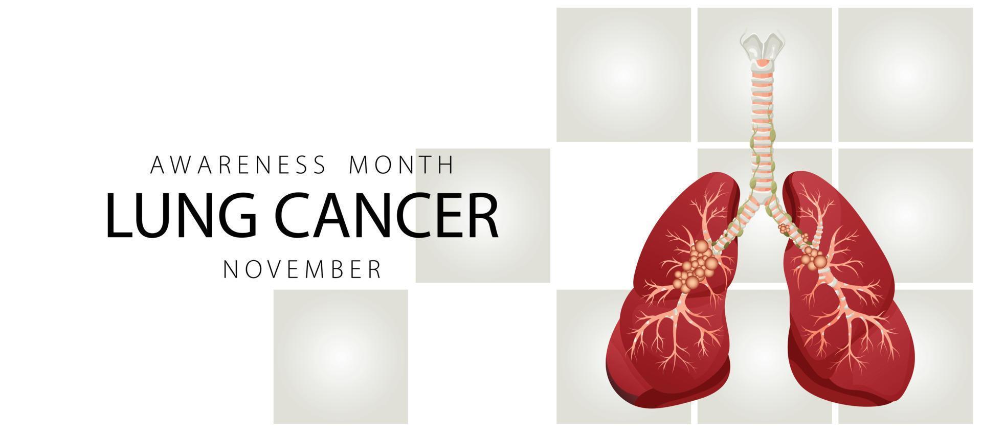 Banner informing about lung cancer. Design template for websites, magazines. Vector illustration cartoon style.