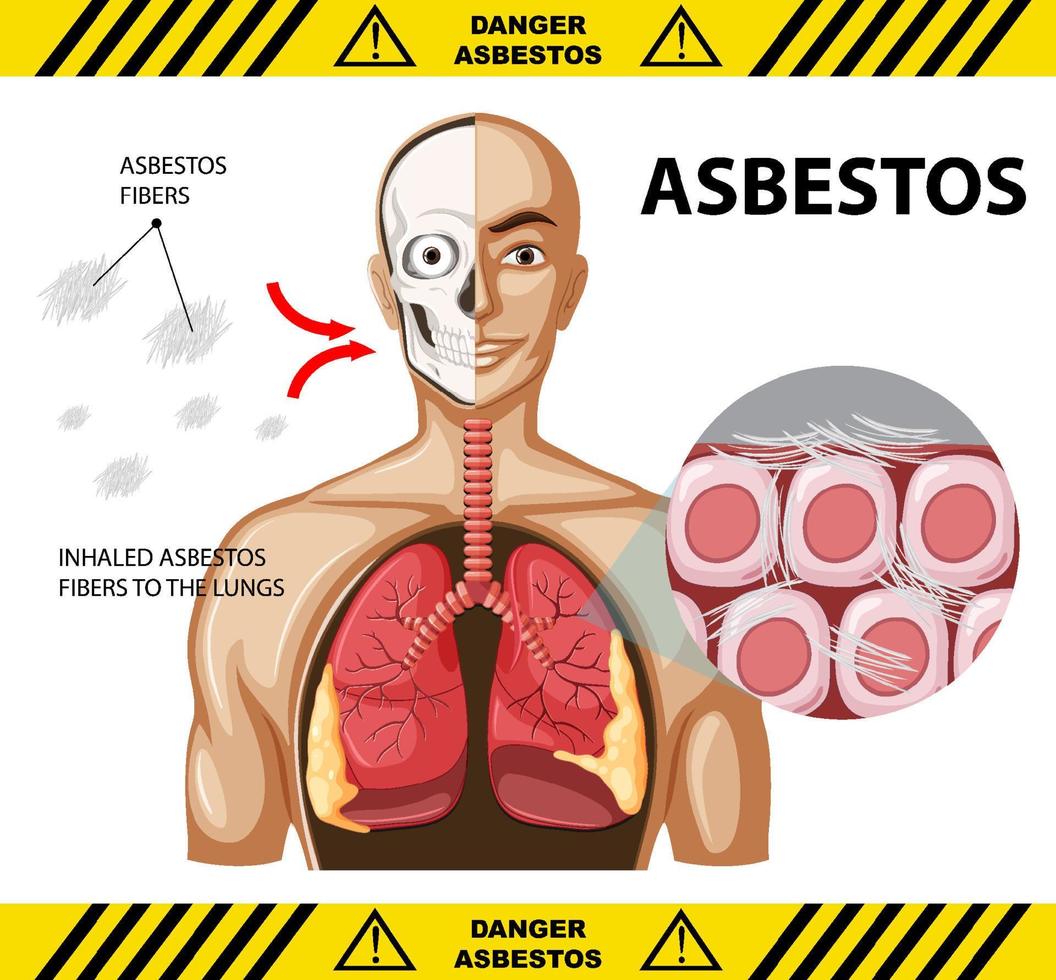 Diagram showing asbestosis in lungs vector