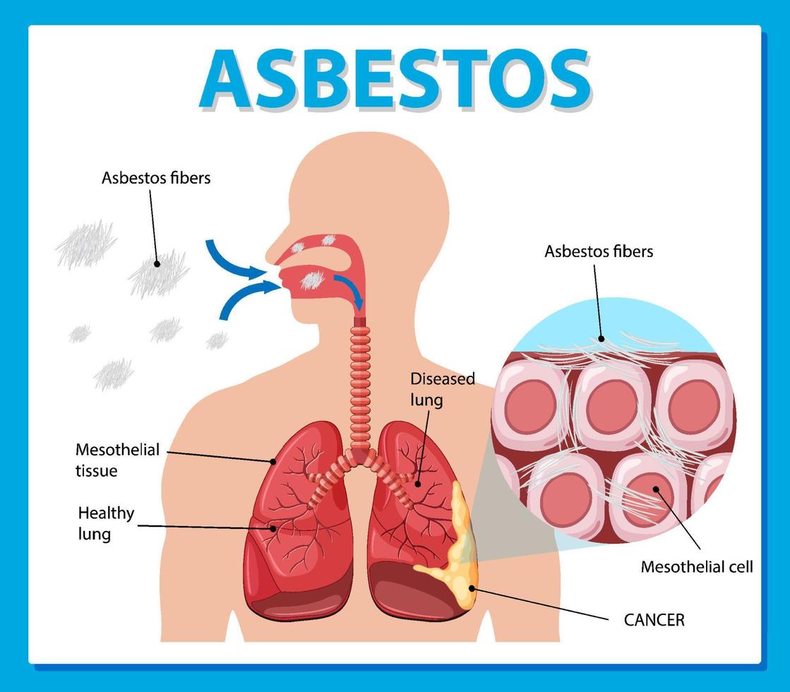 Diagram showing asbestosis in lungs vector