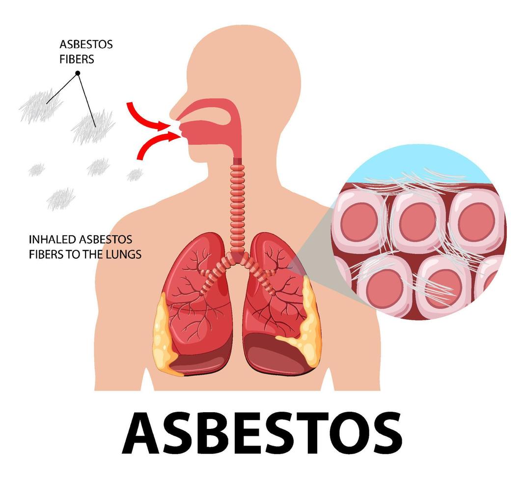 Diagram showing asbestosis in lungs vector