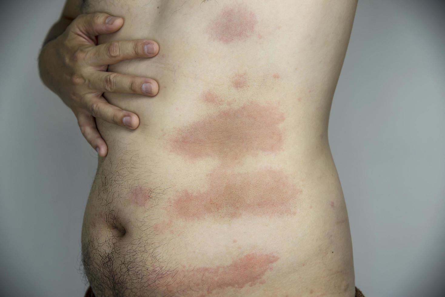hombre con erupción cutánea roja en su parte del cuerpo - personas con concepto de problema de alergia en la piel foto