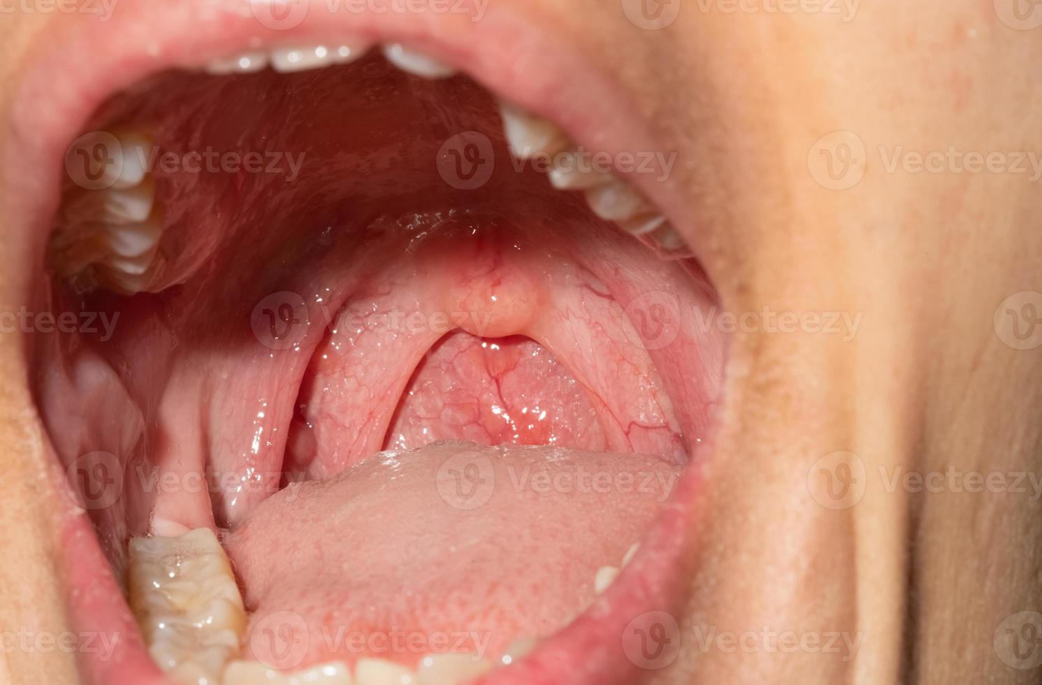 Sore throat with throat swollen. Closeup open mouth with posterior pharyngeal wall swelling and uvula and tonsil. Influenza follicles in the posterior pharyngeal wall. Upper respiratory tract. photo