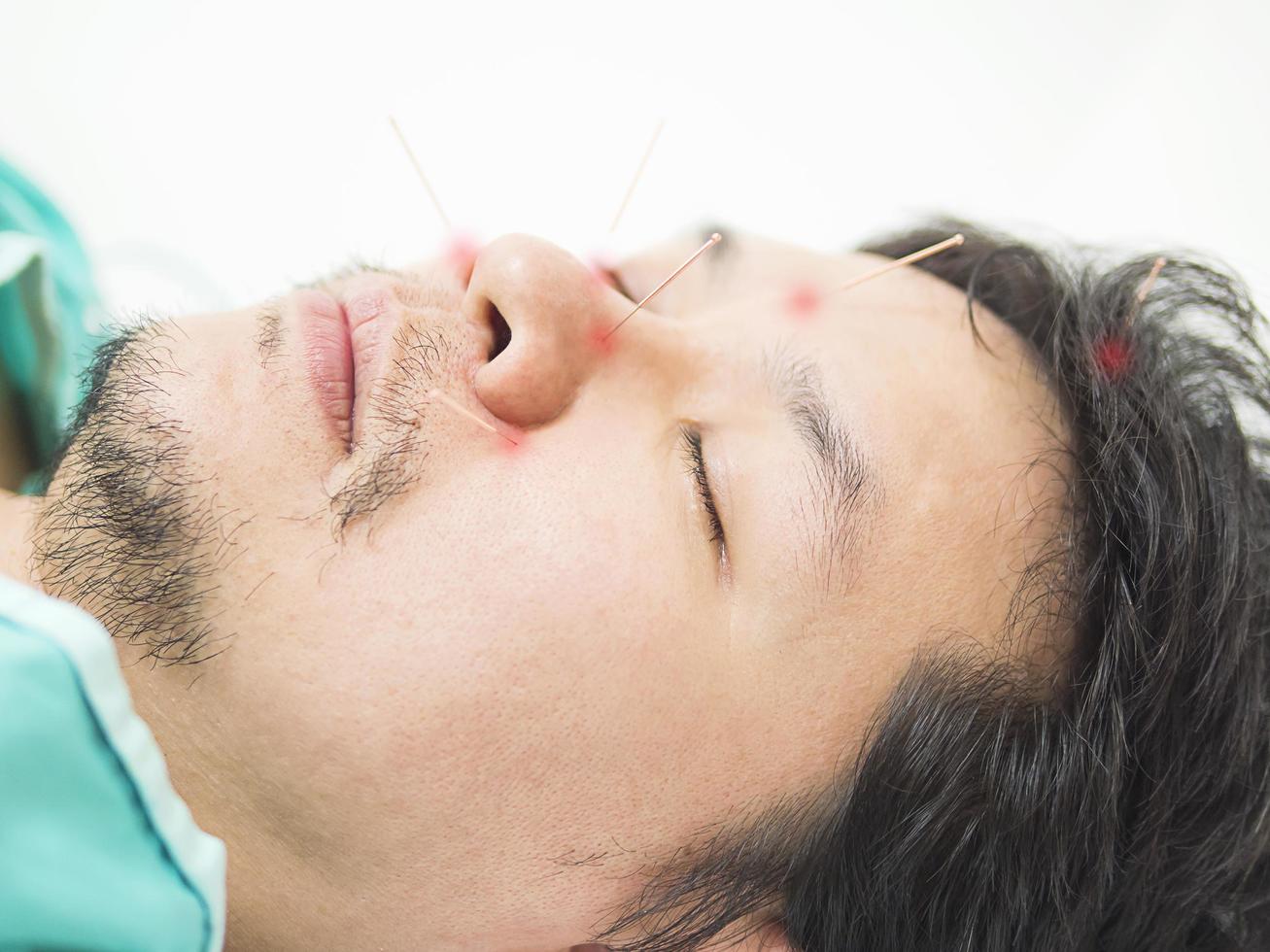 Asian man is receiving Acupuncture treatment. The red dots at needle end is artificially making for easier noticeable the needle position. photo