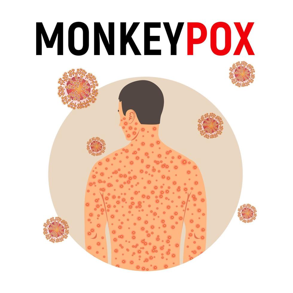 Man sick with monkey smallpox in flat style isolated on white background. Background with monkey pox virus. Vector illustration.