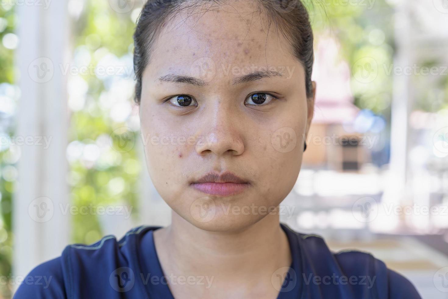 Young Asian woman worry about her face when she has problems with skin on her face in a natural background. Problems with acne and scar on the female skin. Problem skincare and health concept. photo