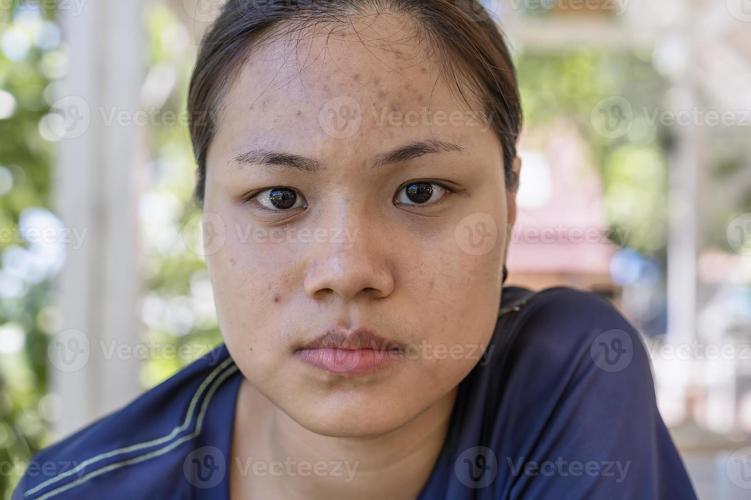 Young Asian woman worry about her face when she has problems with skin on her face in a natural background. Problems with acne and scar on the female skin. Problem skincare and health concept. photo