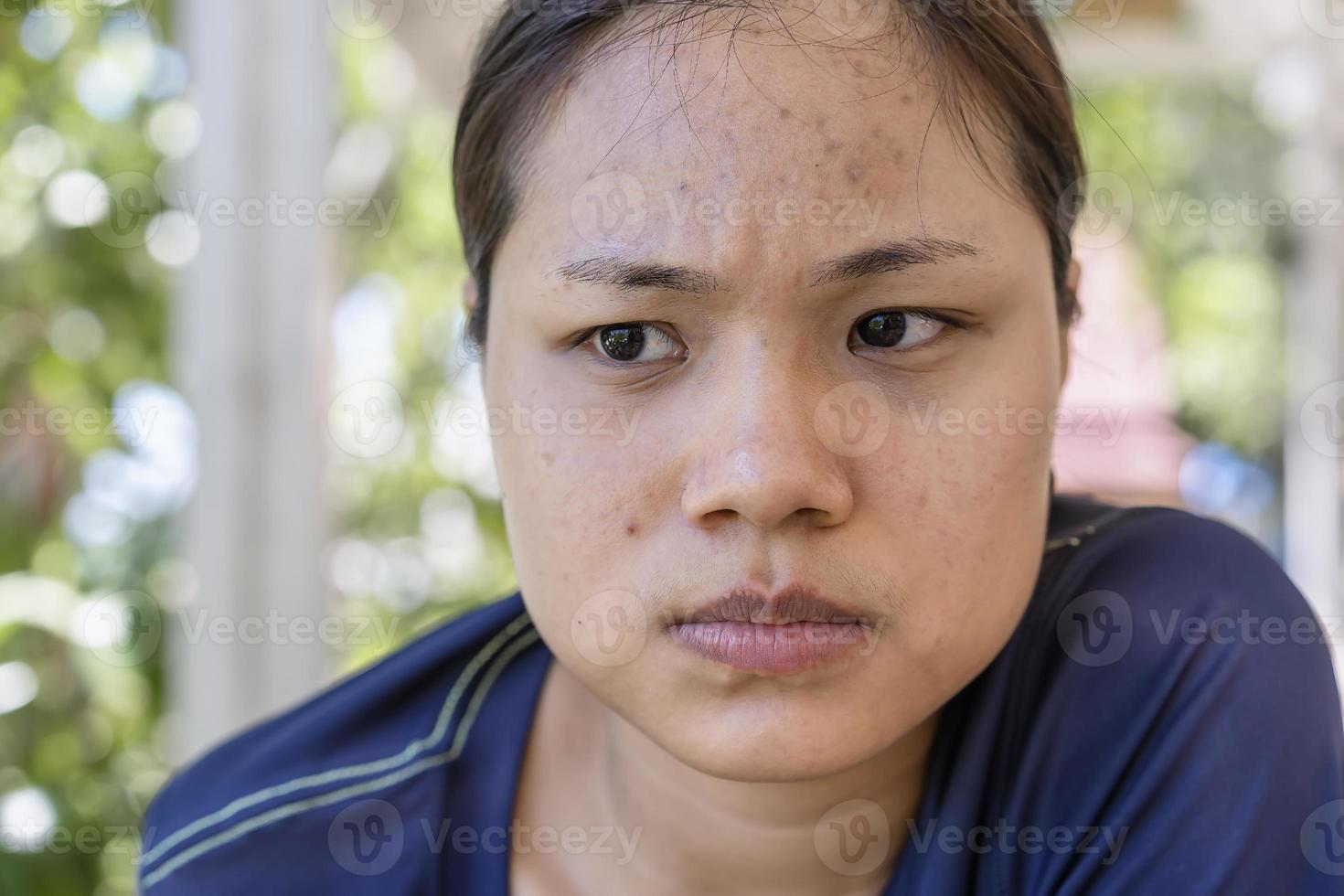 Young Asian woman worry about her face when she has problems with skin on her face in a natural background. Problems with acne and scar on the female skin. Problem skincare and health concept. photo