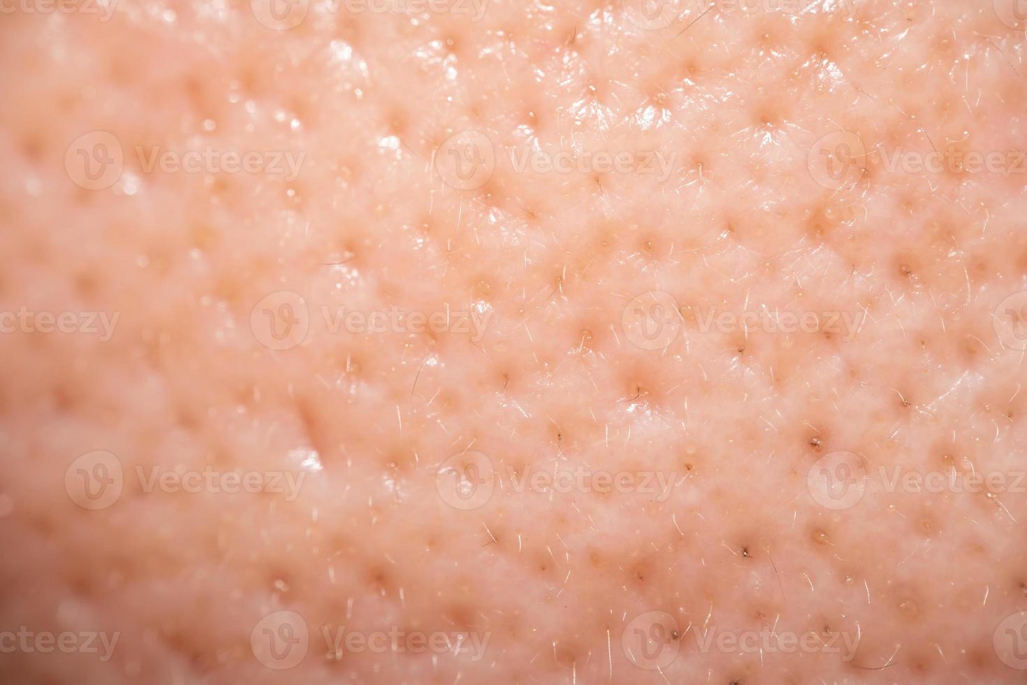 Asian male nose and cheek close up has skin problem, large pores, whitehead and blackhead pimple. Pores on the face of a man. photo