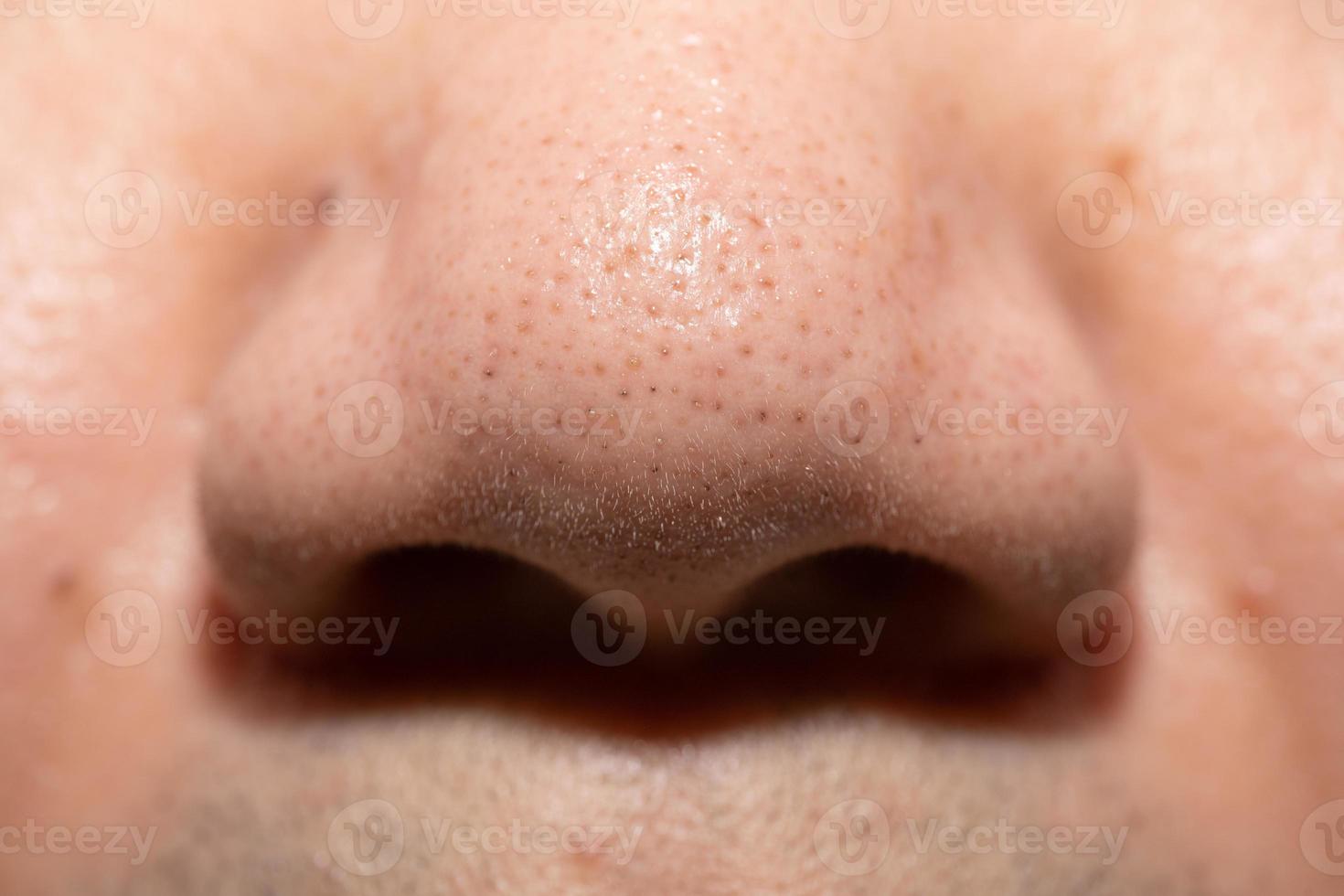 Pimples, clogged acne around the nose of men photo