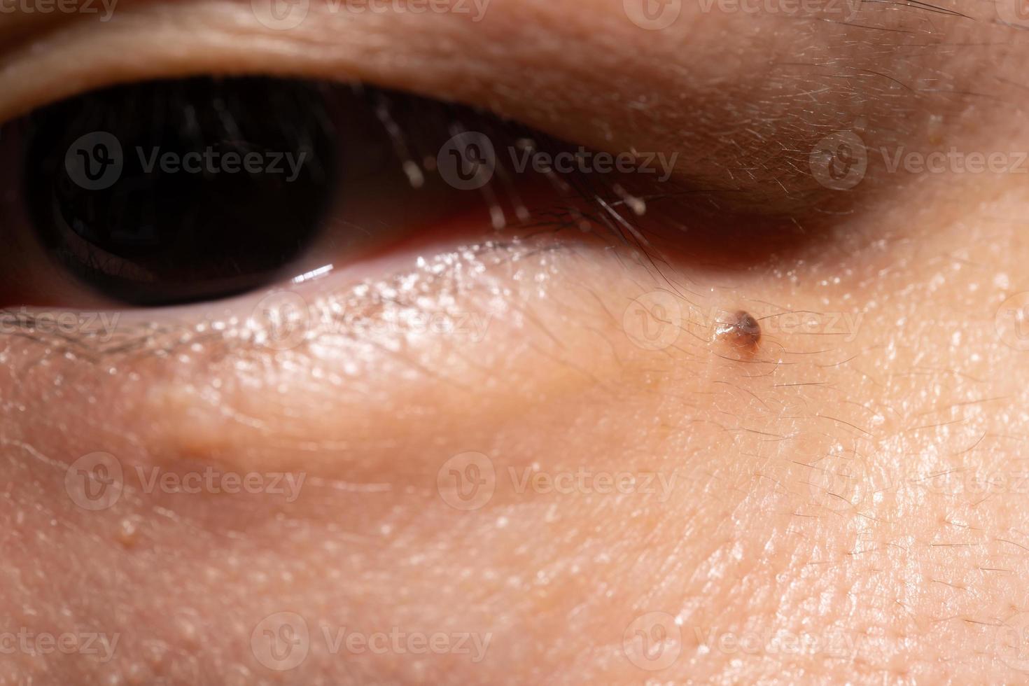 mole under the eyes of a man, pigmentation on the face photo