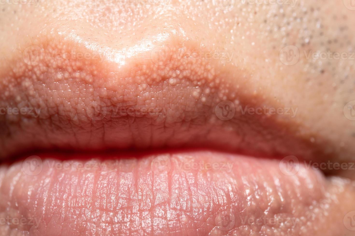 close up of Fordyce Spots on Lips. photo