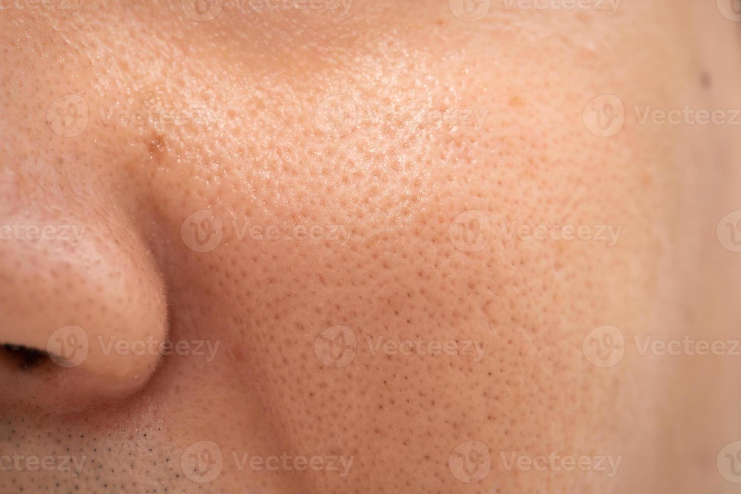 Asian male nose and cheek close up has skin problem, large pores, whitehead and blackhead pimple. Pores on the face of a man. photo