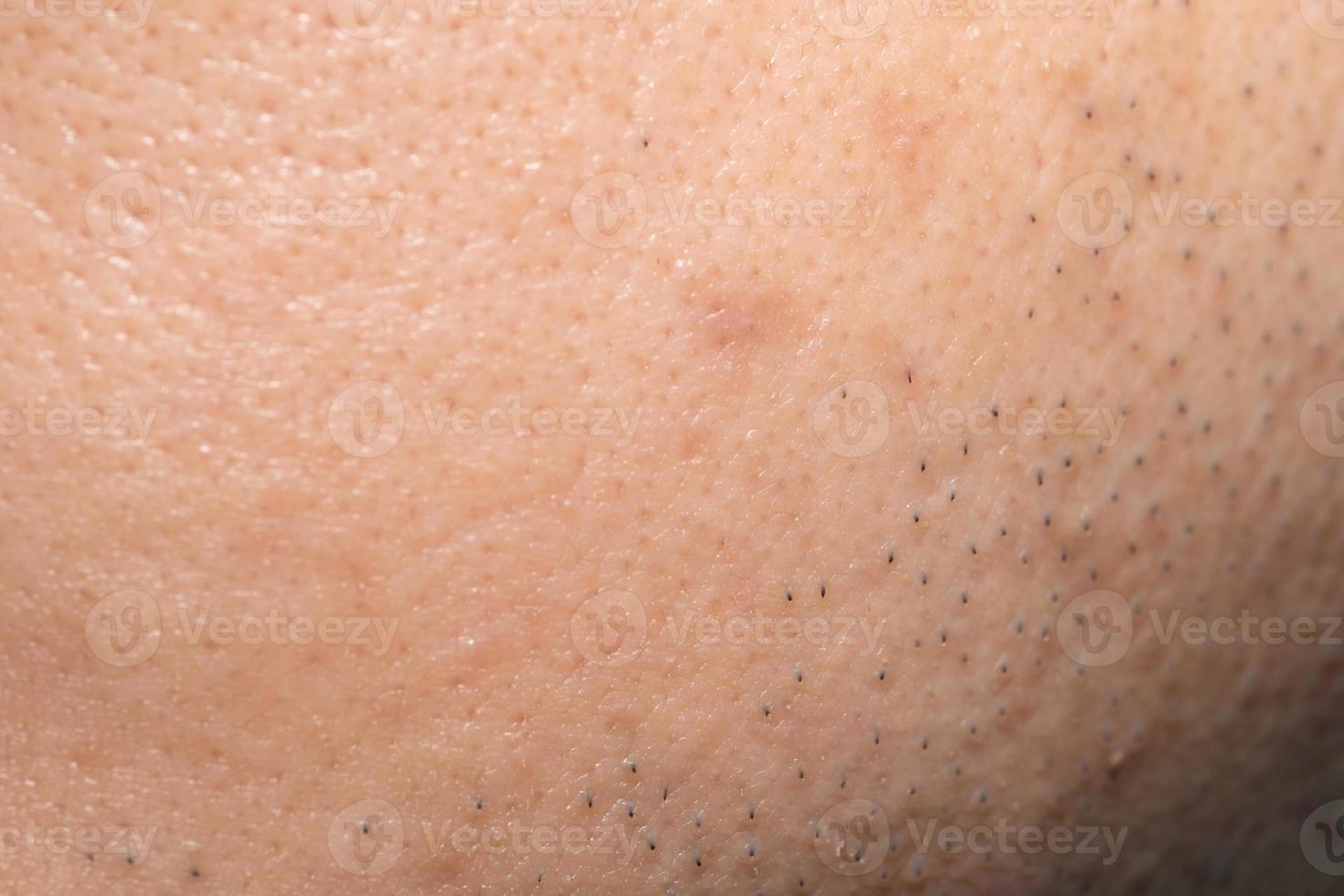 Asian male nose and cheek close up has skin problem, large pores, whitehead and blackhead pimple. Pores on the face of a man. photo