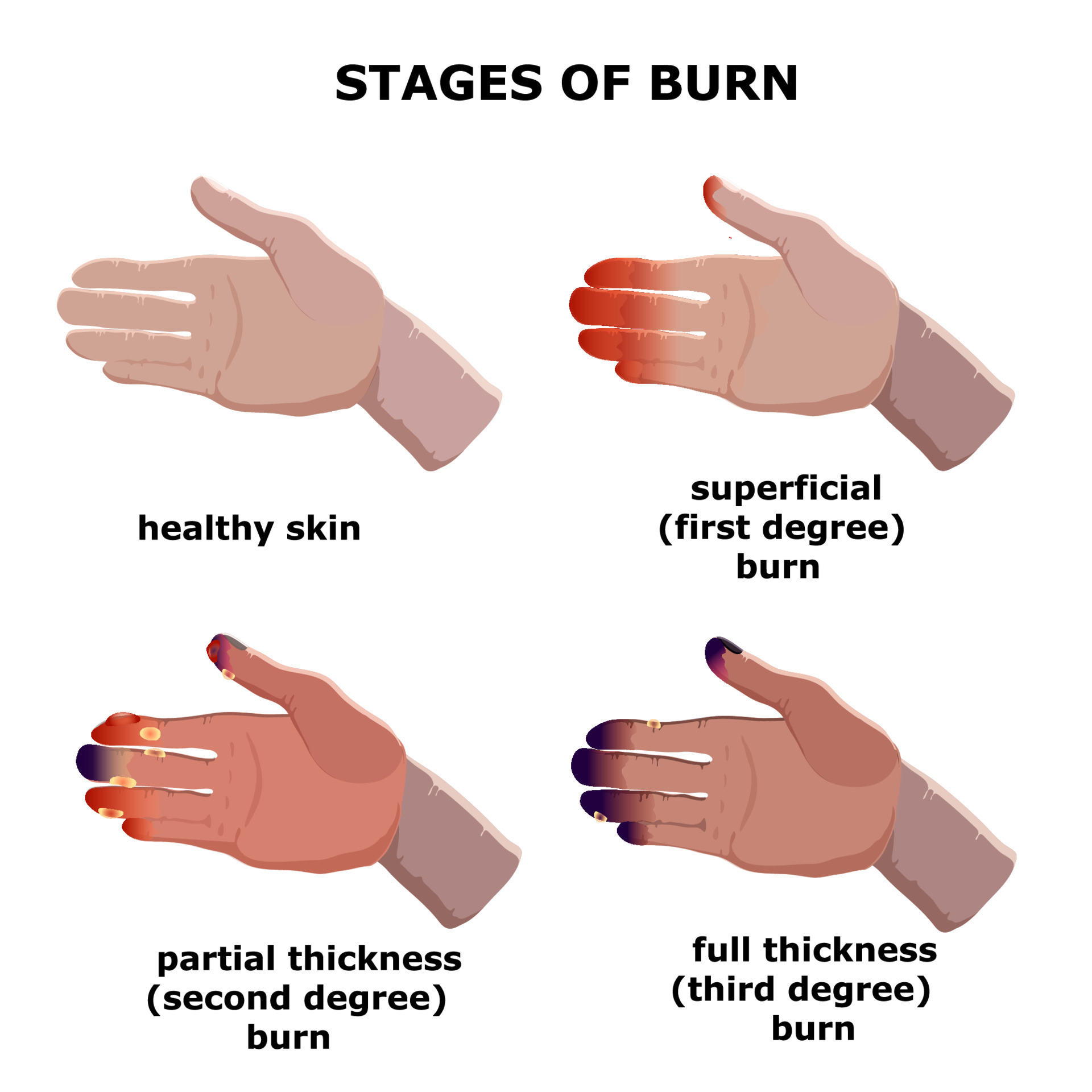 Medical Vector Illustration Burn Stages Degree Burns Of Skin 8910124 