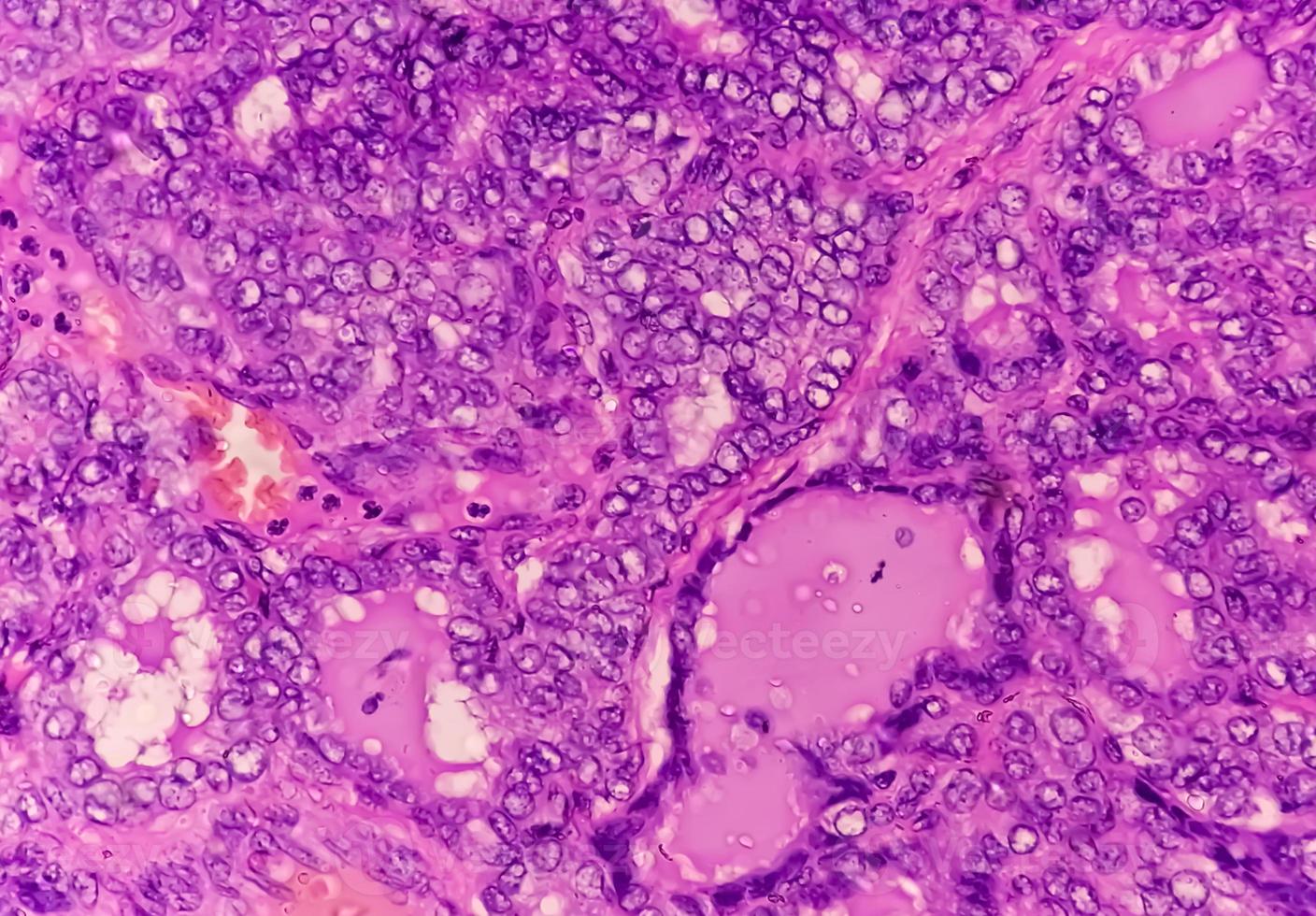 Thyroid cancer, Microscopic image of Metastatic papillary carcinoma of thyroid, central lymph node. photo
