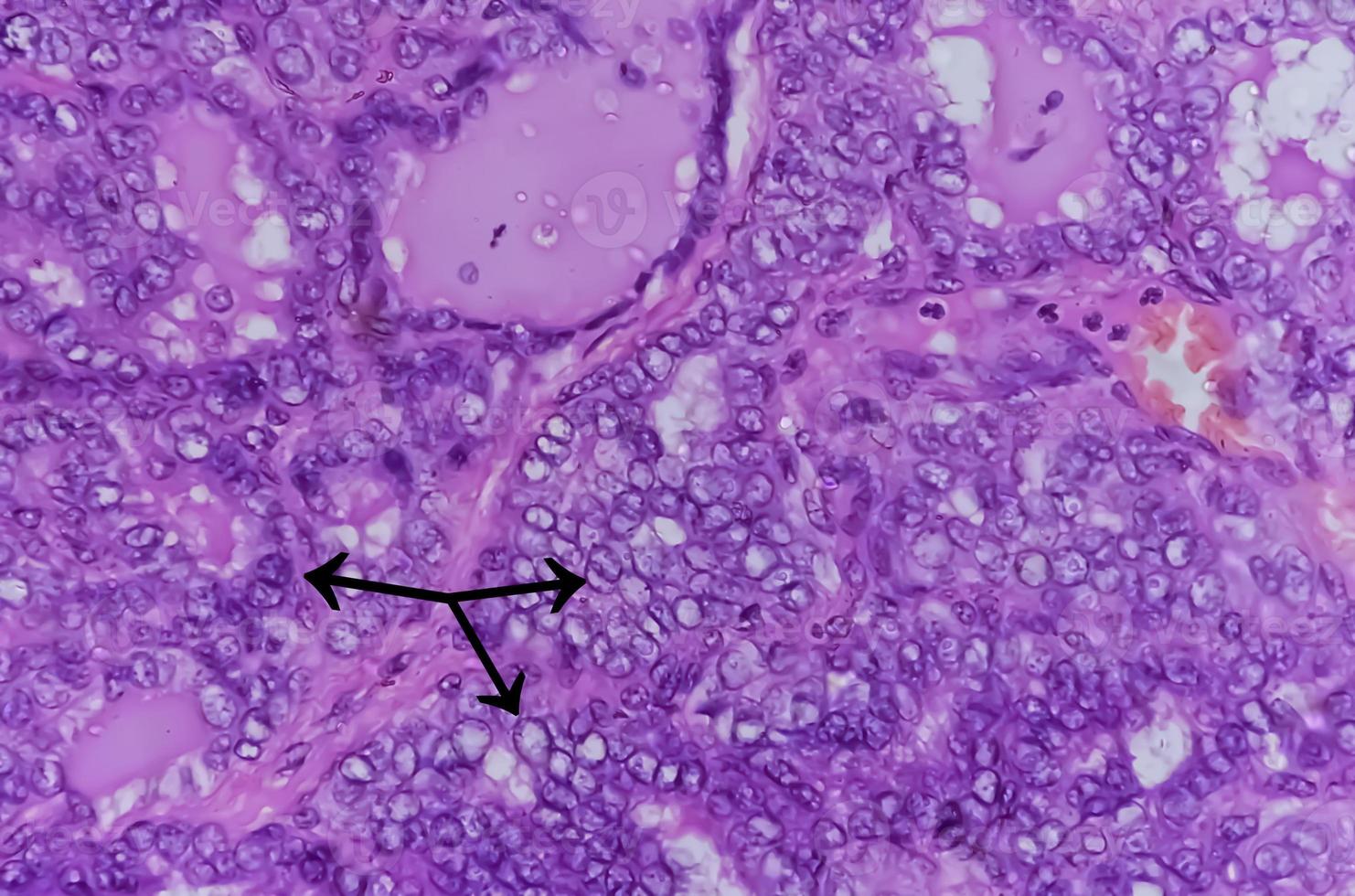 Thyroid cancer, Microscopic image of Metastatic papillary carcinoma of thyroid, central lymph node. photo