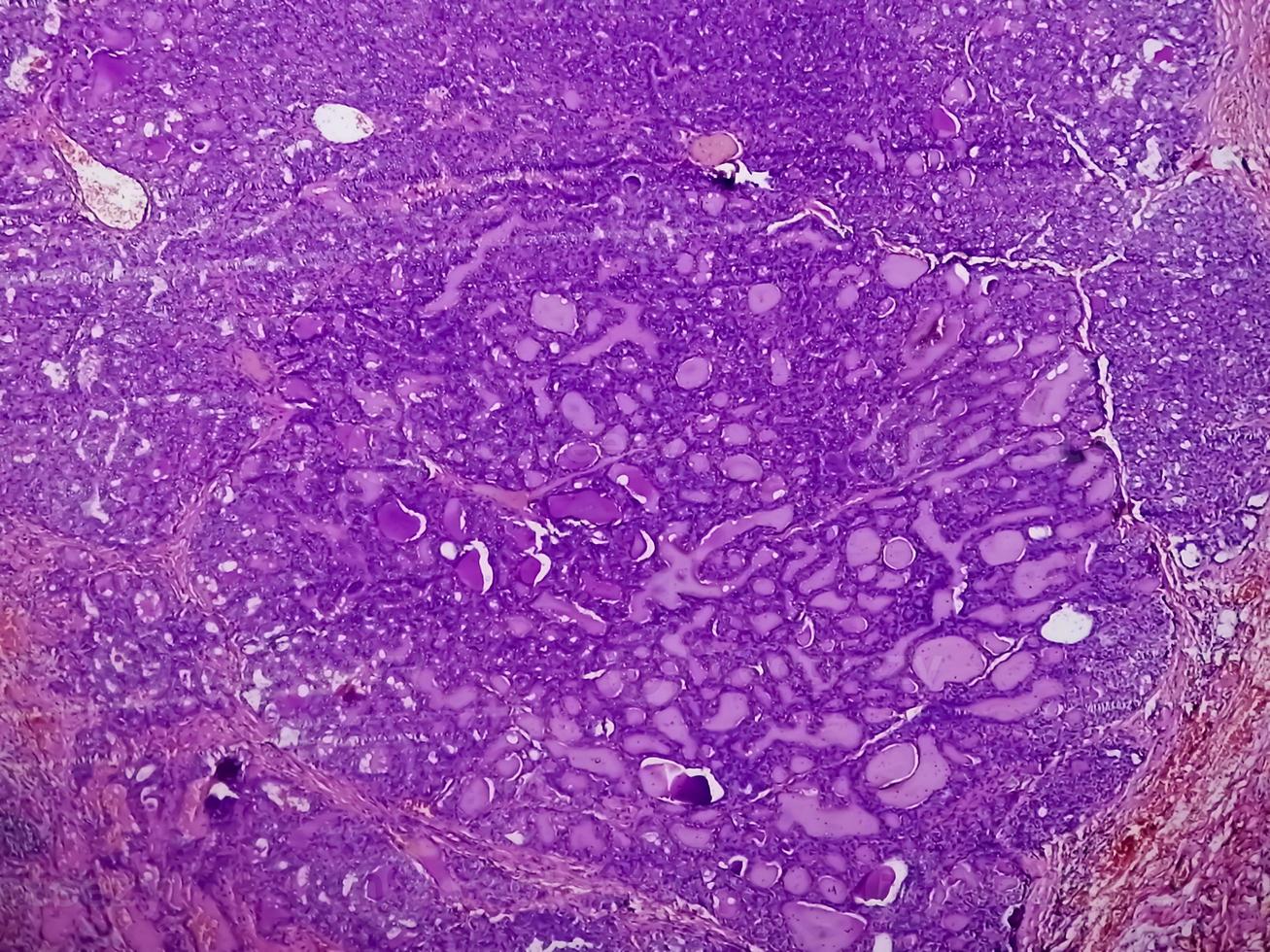 Thyroid cancer, Microscopic image of Metastatic papillary carcinoma of thyroid, central lymph node. photo