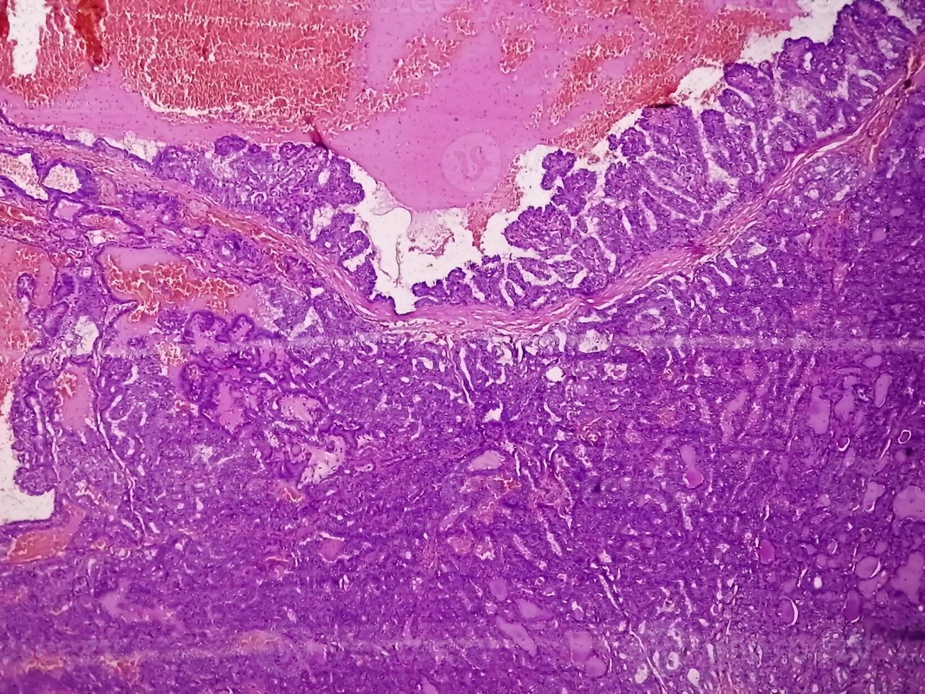 Thyroid cancer, Microscopic image of Metastatic papillary carcinoma of thyroid, central lymph node. photo