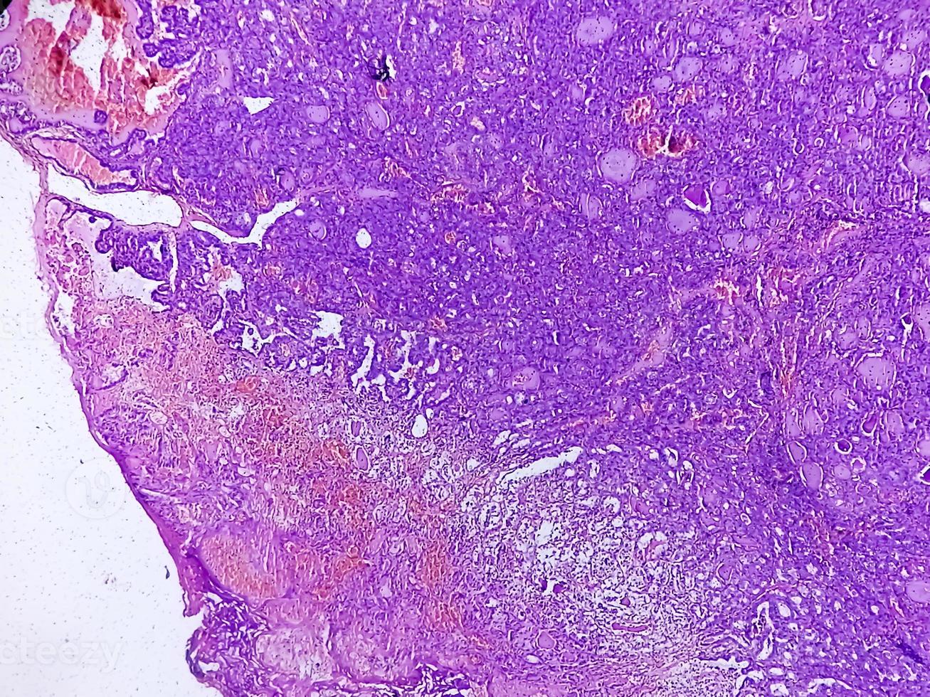 cáncer de tiroides, imagen microscópica de carcinoma papilar metastásico de tiroides, ganglio linfático central. foto