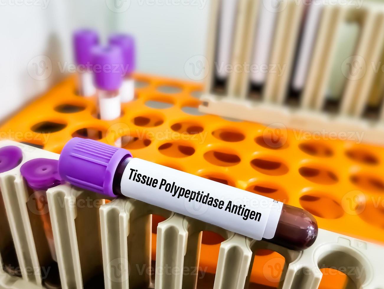 Tissue polypeptide antigen or TPA test for the diagnosis of urogenital cancer or bladder cancer photo