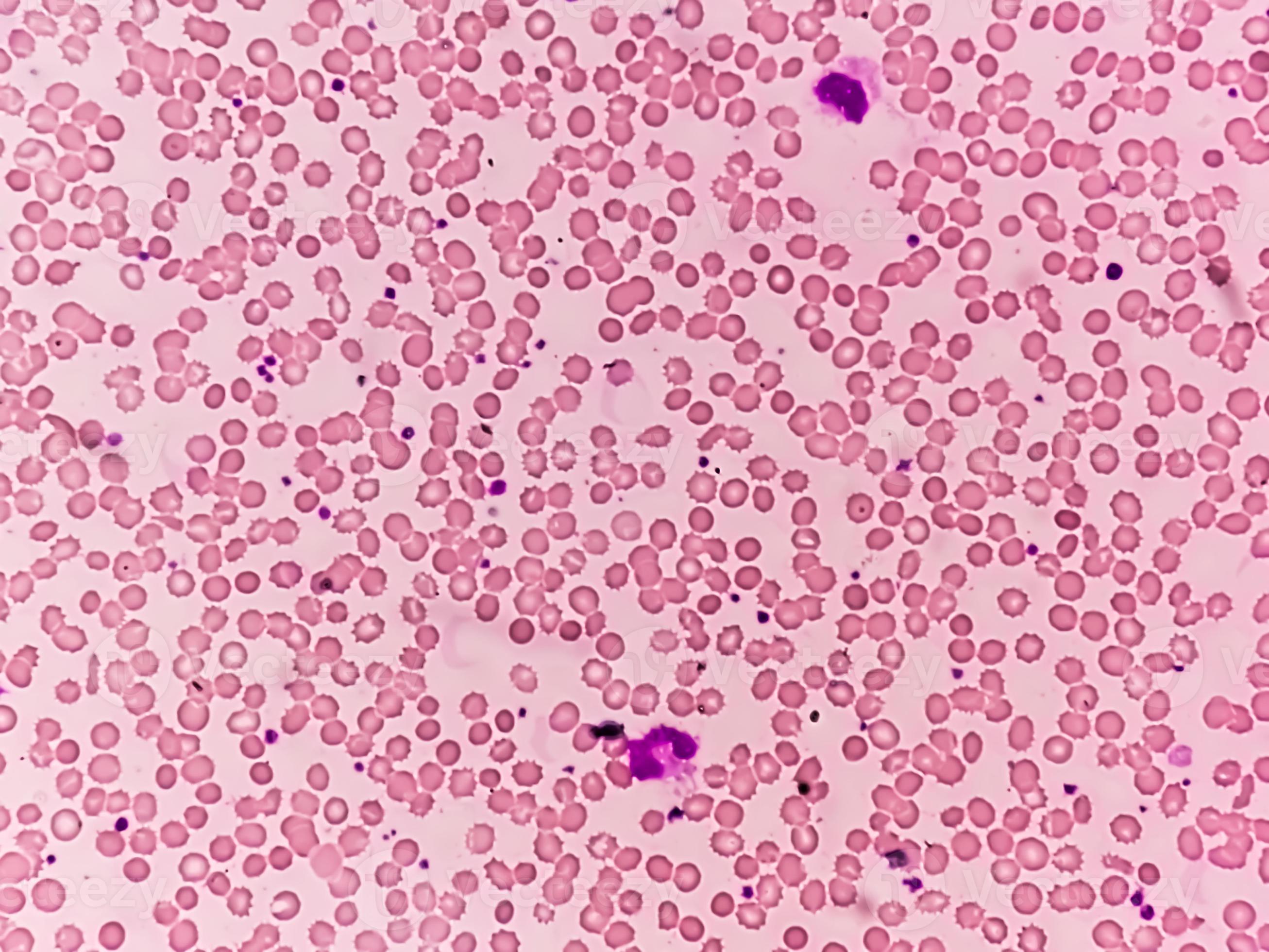 Photomicrograph or microscopic image showing Hemoglobin D trait with