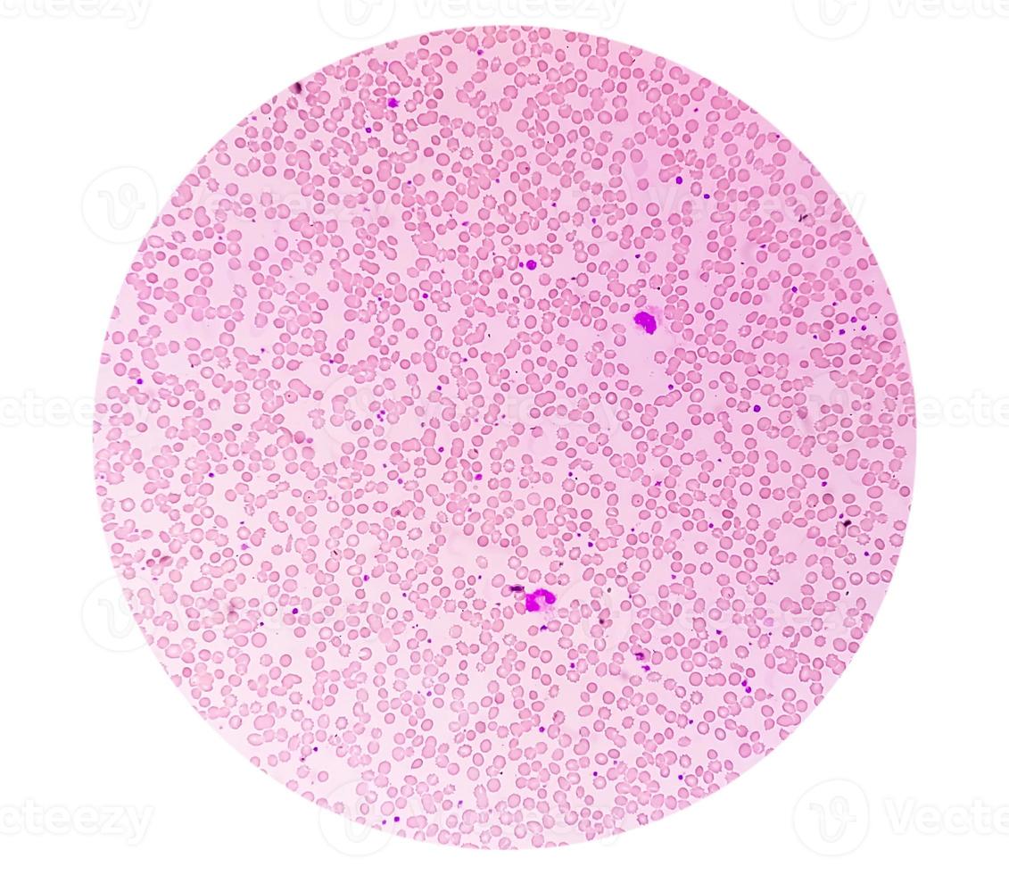Photomicrograph or microscopic image showing Hemoglobin D trait with iron deficiency anemia. photo