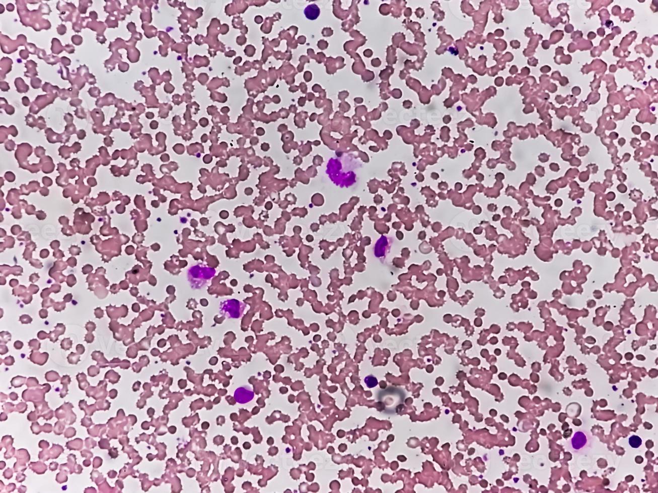 Photomicrograph or microscopic image showing Hemoglobin D trait with iron deficiency anemia. photo