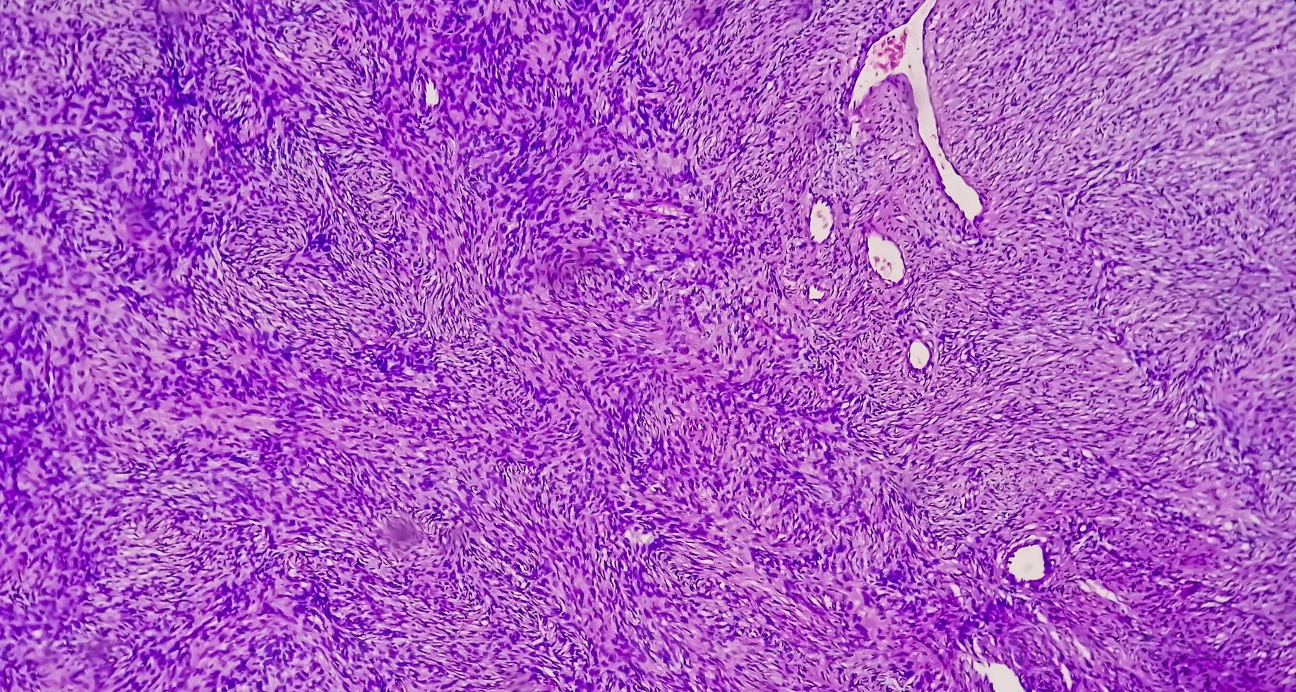 Photomicrograph of a schwannoma, a benign soft tissue tumor of peripheral nerve sheath. photo