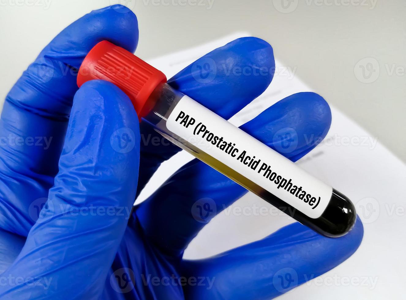 Blood sample for prostatic acid phosphatase test in laboratory for prostate cancer diagnosis. photo