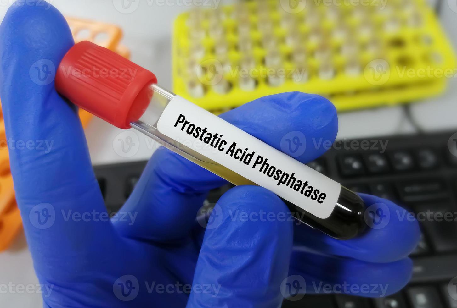 muestra de sangre para la prueba de fosfatasa ácida prostática en laboratorio para el diagnóstico de cáncer de próstata. foto