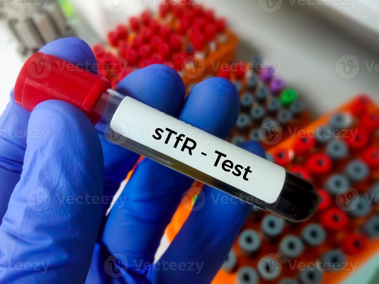 Soluble transferrin receptor or sTfR test. this test help to detect and evaluate iron deficiency and aid in the diagnosis of iron deficiency anemia. photo