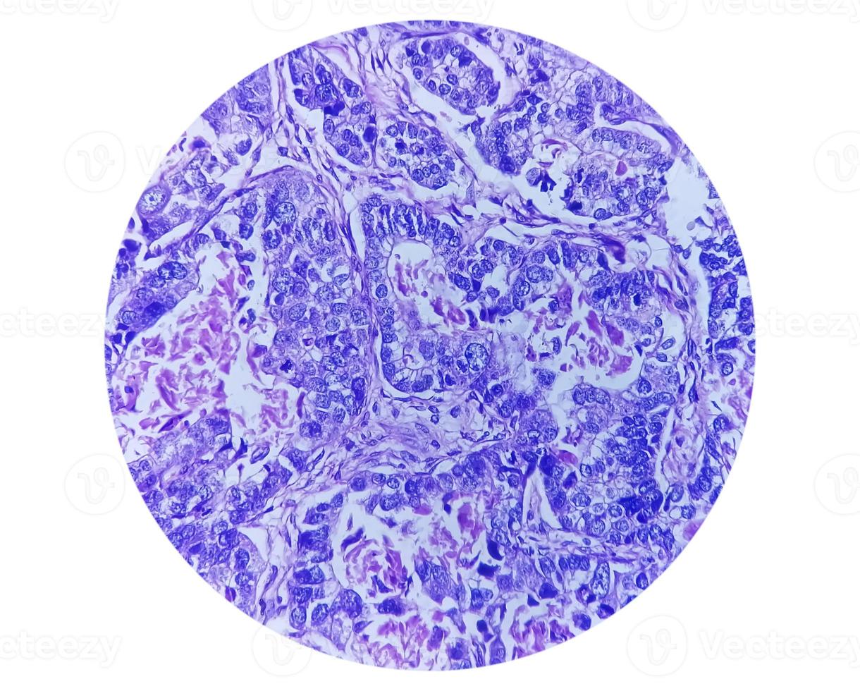 Photomicrograph or microscopic image of Stomach cancer. Adenocarcinoma of stomach photo