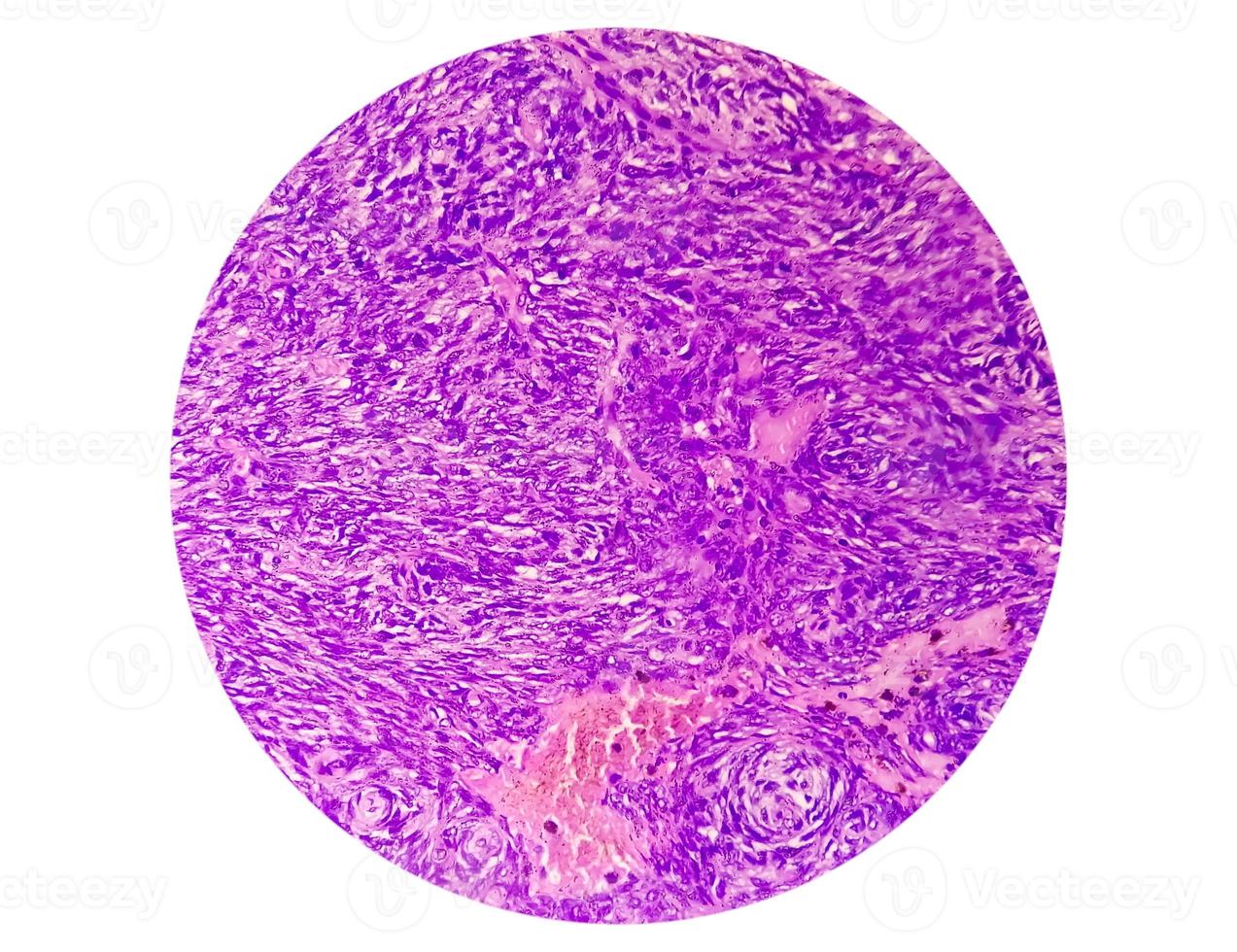 Photomicrograph of a schwannoma, a benign soft tissue tumor of peripheral nerve sheath. photo