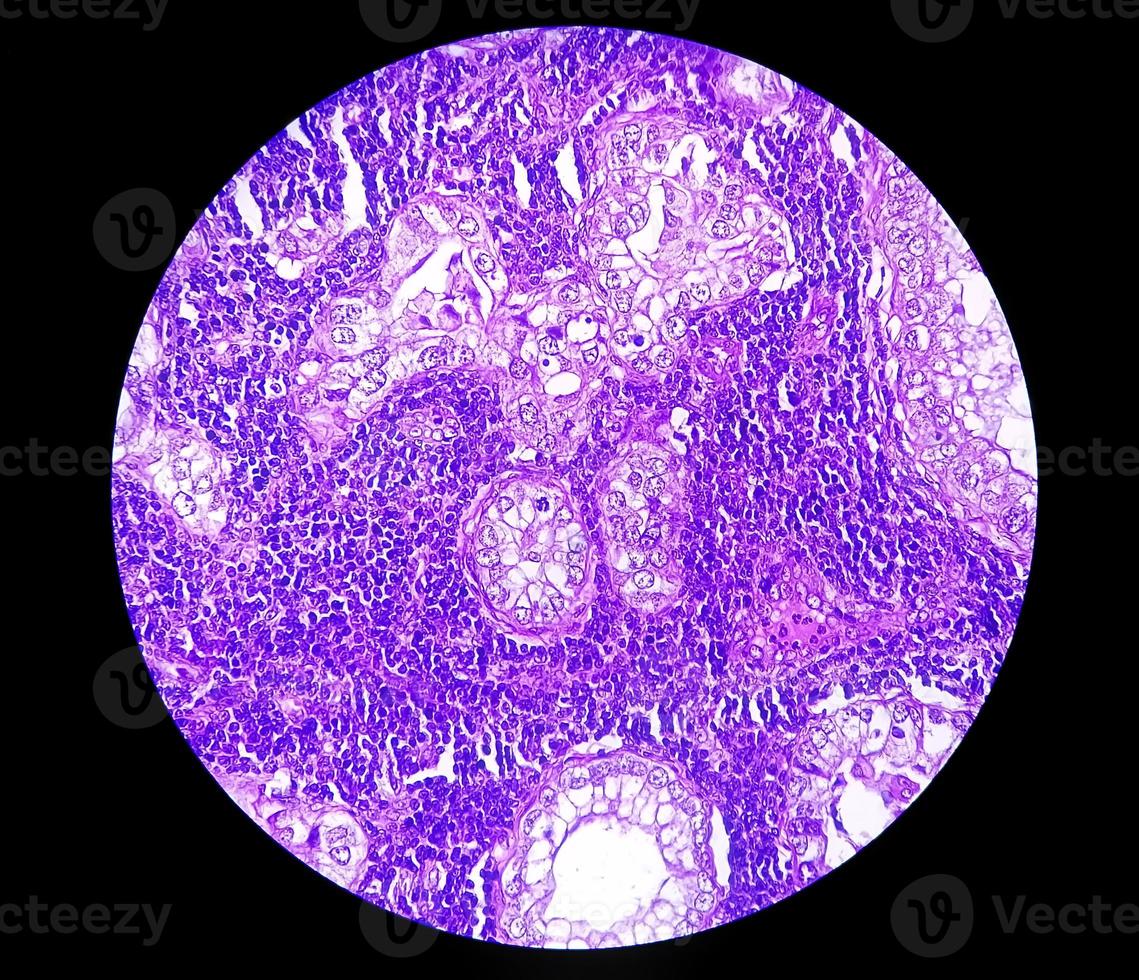 fotomicrografía o imagen microscópica del cáncer de estómago. adenocarcinoma de estómago foto