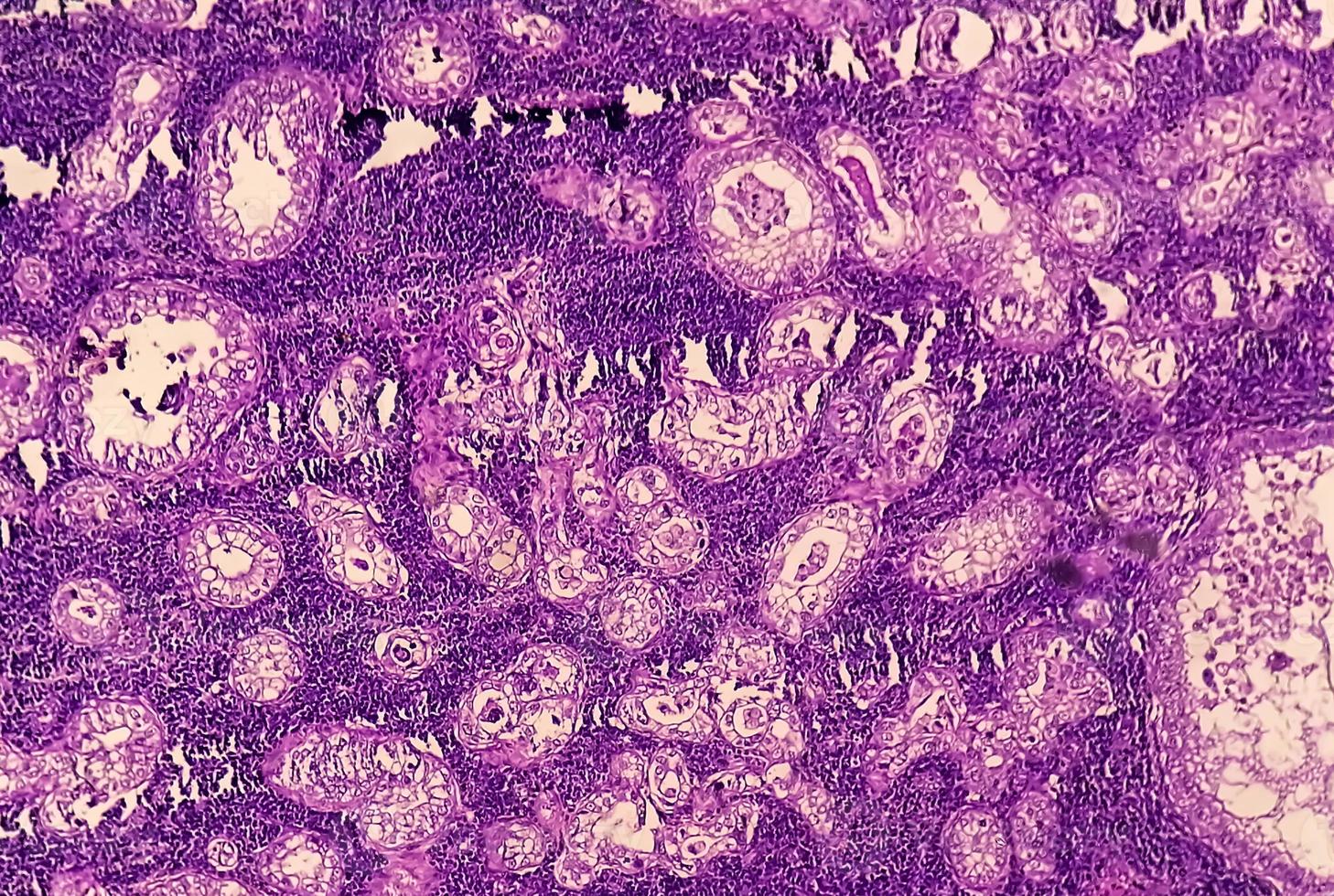 Photomicrograph or microscopic image of Stomach cancer. Adenocarcinoma of stomach photo