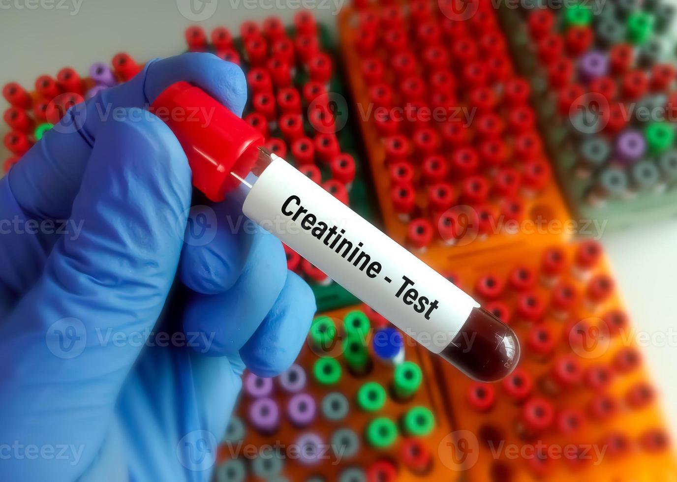 Blood sample for creatinine test. Diagnosis of kidney or renal disease photo